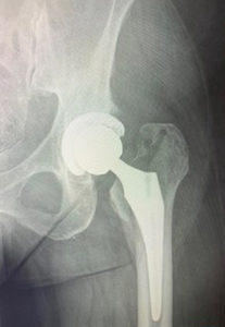 anterior-total-hip-before Image