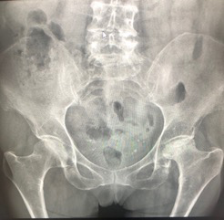 severe-left-hip-pain Image