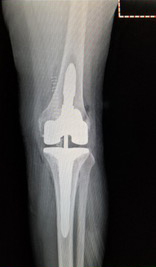 total-knee-replacement Image