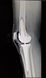 total-knee-replacement Image